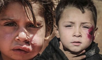 İdlib’deki sığınmacı kamplarında şark çıbanı hastalığı yayılıyor