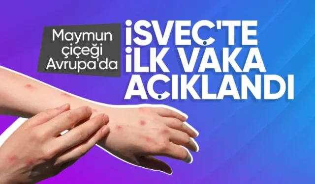 Maymun çiçeği virüsü İsveç'te görüldü